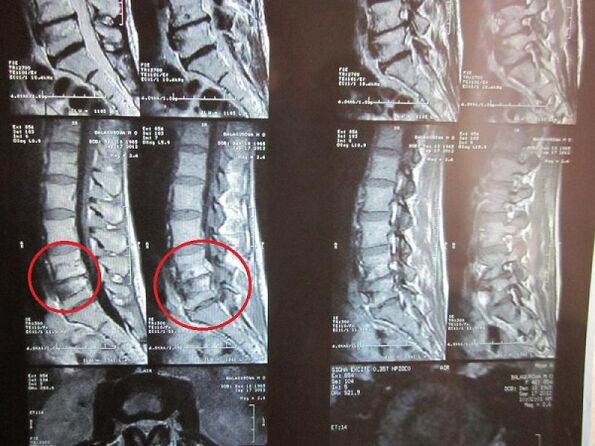 Bachadon bo'yni ostondondrozni tashxislash