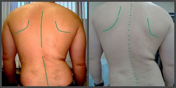 Osteokondroz bilan umurtqa pog'onasining egriligi