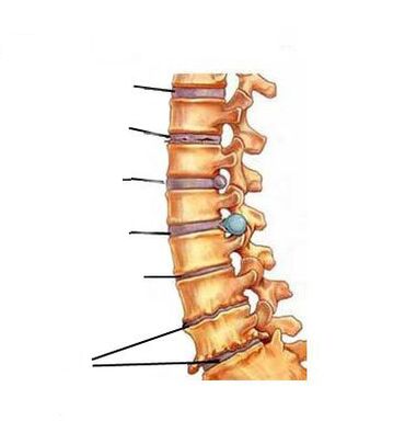 Ostookondroz qanday rivojlanadi