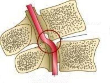 Panjara arteriya sindromi