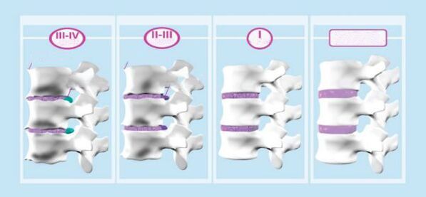 Servikal ostondroz bosqichlari