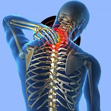 bachadon bo'yli osteokondroz bilan bo'yin og'rig'i
