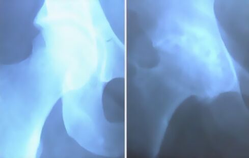 Tizza bo'g'imlarining artizasi ko'pik