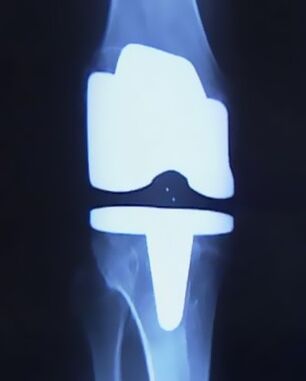 Xrayotning bo'g'imidan keyin sun'iy protez bilan tizzaning rasmini