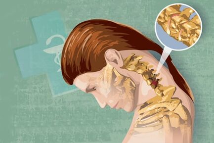 Osteokondrozning refleks belgilari